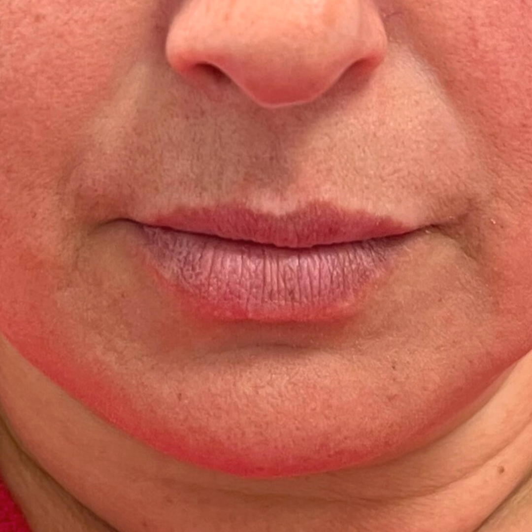 Lip Filler Archives Mountcastle Medical Spa And Laser Center