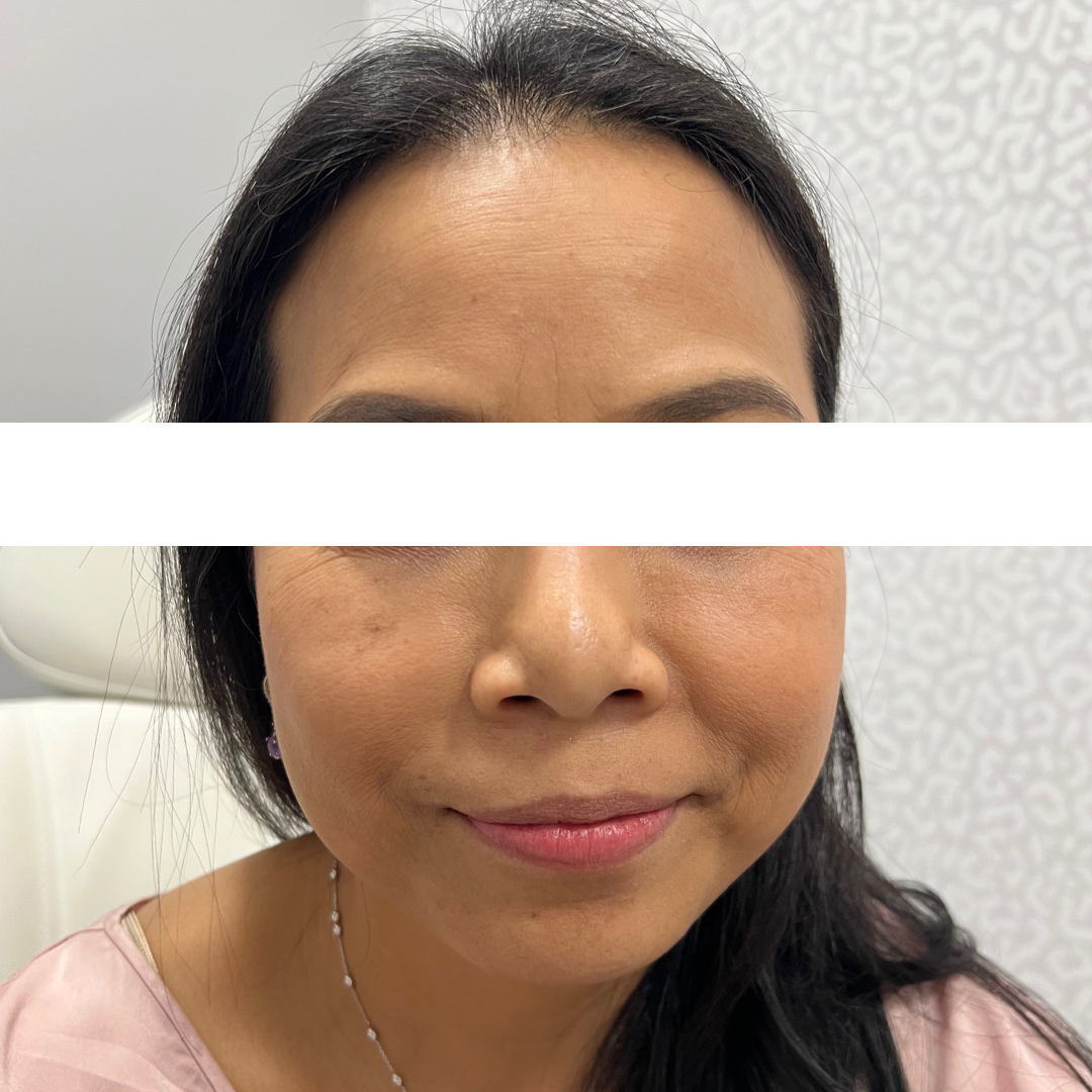 Cheek Filler Archives Mountcastle Medical Spa And Laser Center