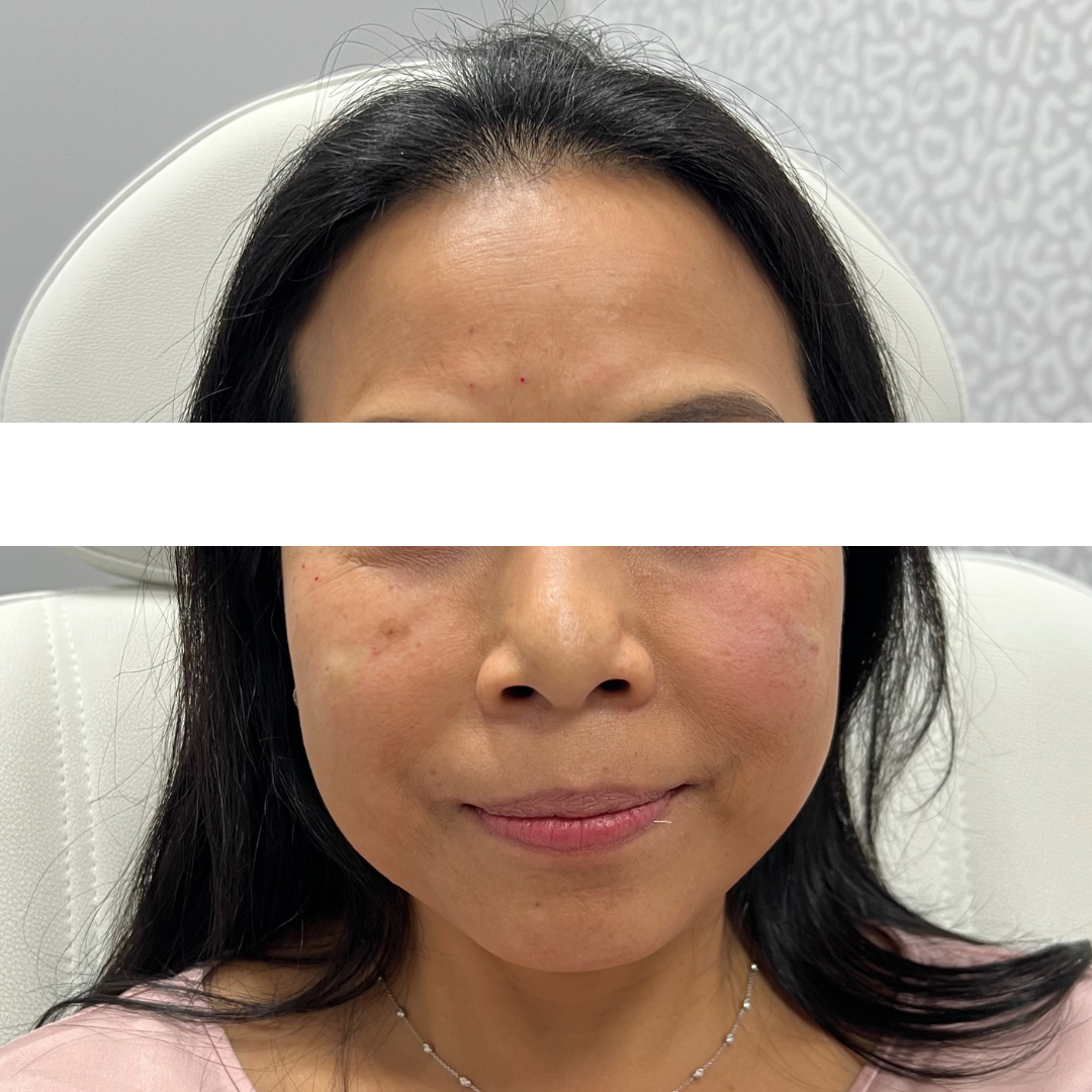 Cheek Filler Archives Mountcastle Medical Spa And Laser Center