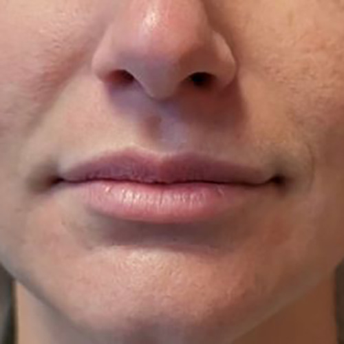 Lip Filler Archives Mountcastle Medical Spa And Laser Center