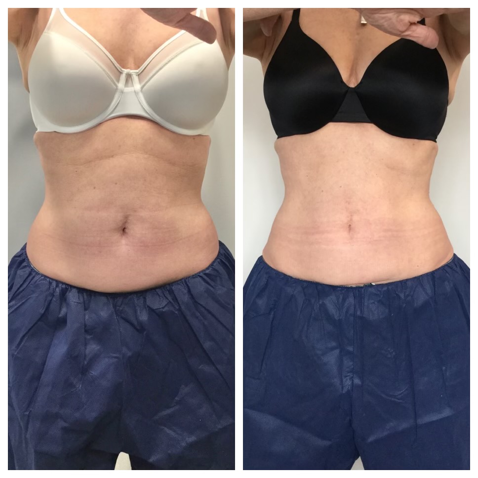 Coolsculpting Before and After Results